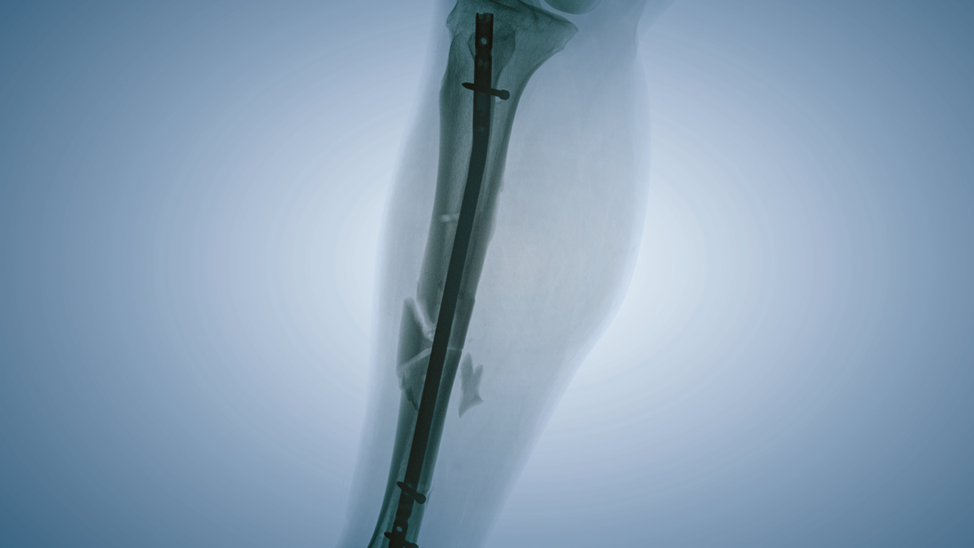 X ray image for Principles of Intramedullary Nailing 